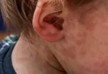 Estudian un nuevo caso sospechoso de sarampión en Entre Ríos