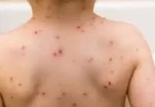 Alerta sarampión: el Municipio lanzó una campaña de vacunación en barrios de Paraná